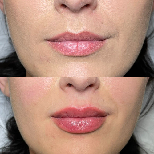 How Much Does 05ml Of Lip Filler Cost